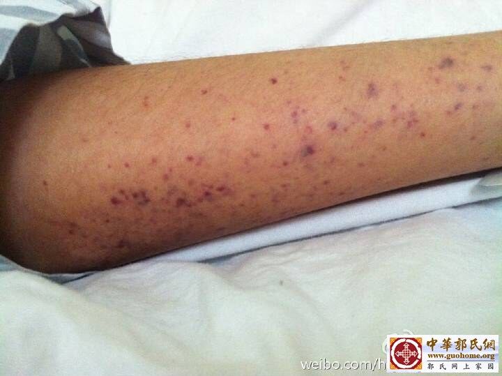血小板低下手脚的出血点